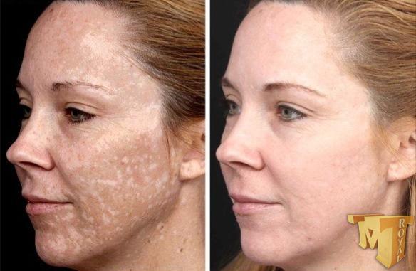 هیدروکینون