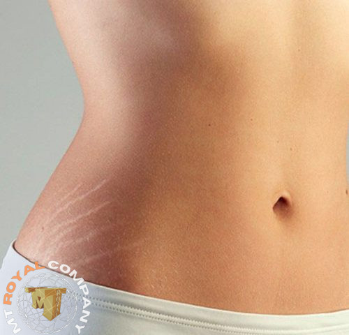 رفع ترک شکم با کره کاکائو